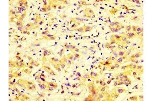 IHC image of ABIN7150786 diluted at 1:600 and staining in paraffin-embedded human liver cancer performed on a Leica BondTM system. (DUSP9 antibody  (AA 142-263))