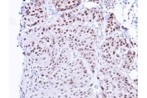 IHC-P Image Immunohistochemical analysis of paraffin-embedded Cal27 Xenograft, using TBLR1 , antibody at 1:100 dilution.
