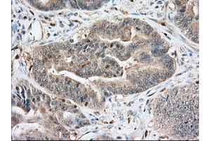 Immunohistochemistry (IHC) image for anti-Insulin-Like Growth Factor 2 mRNA Binding Protein 2 (IGF2BP2) antibody (ABIN1498822) (IGF2BP2 antibody)
