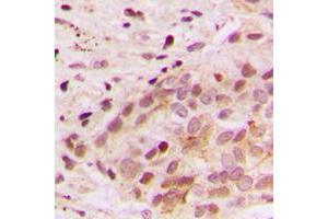Immunohistochemical analysis of ERK3 staining in human breast cancer formalin fixed paraffin embedded tissue section. (MAPK6 antibody  (Center))