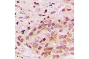Immunohistochemical analysis of ERK3 staining in human breast cancer formalin fixed paraffin embedded tissue section.