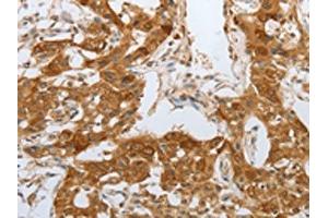 The image on the left is immunohistochemistry of paraffin-embedded Human lung cancer tissue using ABIN7191700(NPY1R Antibody) at dilution 1/25, on the right is treated with synthetic peptide. (NPY1R antibody)