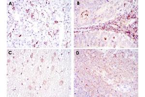 Immunohistochemical analysis of paraffin-embedded human cervical cancer tissues (A), colon cancer tissues (B), brain tissues (C) and submaxillary tumor tissues (D) using CD1A monoclonal antibody, clone 7A7  with DAB staining. (CD1a antibody)