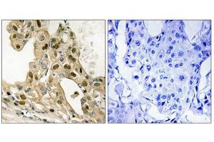 Immunohistochemistry analysis of paraffin-embedded human breast carcinoma tissue using p53 (Phospho-Thr387) antibody. (p53 antibody  (pThr387))