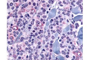 Anti-NANP antibody IHC of human Breast, Carcinoma. (NANP antibody  (Internal Region))