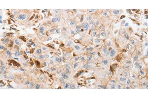Immunohistochemistry of paraffin-embedded Human lung cancer tissue using SLC15A2 Polyclonal Antibody at dilution 1:60 (SLC15A2 antibody)