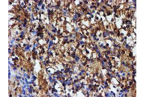 Immunohistochemical staining of paraffin-embedded Carcinoma of Human kidney tissue using anti-IDS mouse monoclonal antibody. (IDS antibody)