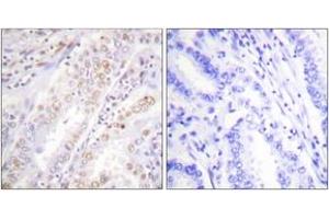 Immunohistochemistry analysis of paraffin-embedded human lung carcinoma, using XRCC2 Antibody.