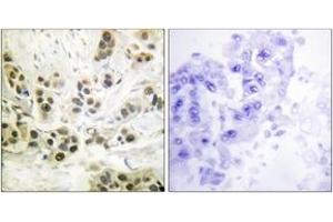 Immunohistochemistry analysis of paraffin-embedded human breast carcinoma, using Lamin A/C (Phospho-Ser392) Antibody. (Lamin A/C antibody  (pSer392))