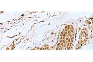 Immunohistochemistry of paraffin-embedded Human esophagus cancer tissue using WRNIP1 Polyclonal Antibody at dilution of 1:35(x200) (WRNIP1 antibody)