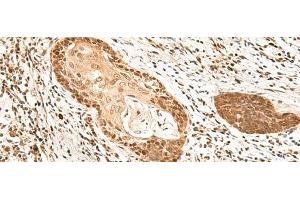 Immunohistochemistry of paraffin-embedded Human esophagus cancer tissue using MKX Polyclonal Antibody at dilution of 1:60(x200) (MKX antibody)