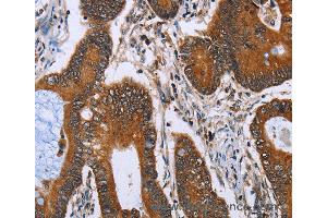 Immunohistochemistry of Human lung cancer using IHH Polyclonal Antibody at dilution of 1:30 (Indian Hedgehog antibody)