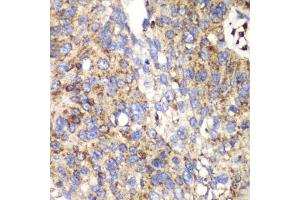 Immunohistochemistry of paraffin-embedded human lung cancer using SPARC antibody (ABIN5970787) at dilution of 1/100 (40x lens). (SPARC antibody)