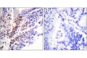 Immunohistochemistry analysis of paraffin-embedded human lung carcinoma, using GR (Phospho-Ser226) Antibody. (GR (AA 201-250), (pSer226) antibody)