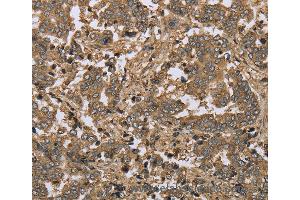 Immunohistochemistry of Human lung cancer using IKBIP Polyclonal Antibody at dilution of 1:30
