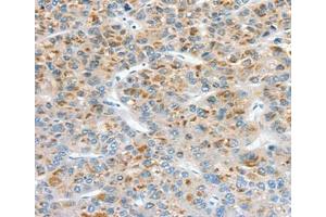 Immunohistochemical analysis of paraffin-embedded Human liver cancer tissue using at dilution 1/30. (Superoxide dismutase copper chaperone antibody  (C-Term))
