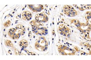 Detection of NFkB in Human Breast cancer Tissue using Polyclonal Antibody to Nuclear Factor Kappa B (NFkB) (NFkB antibody  (AA 42-367))