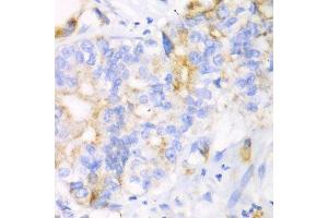 Immunohistochemistry of paraffin-embedded human liver cancer using CHIA antibody.