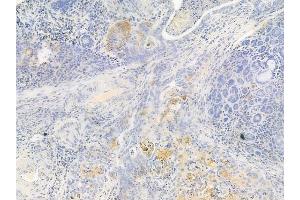 ABIN6262772 and ABIN6267008 at 1/100 staining human esophageal carcinoma by IHC-P. (KRT15 antibody  (N-Term))