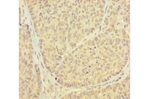 Immunohistochemistry of paraffin-embedded human ovarian cancer using ABIN7164935 at dilution of 1:100