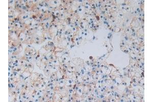 Detection of S100A8 in Human Renal cancer Tissue using Polyclonal Antibody to S100 Calcium Binding Protein A8 (S100A8)