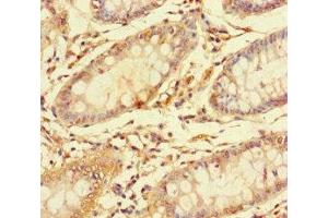 Immunohistochemistry of paraffin-embedded human colon cancer using ABIN7146751 at dilution of 1:100 (CES3 antibody  (AA 65-233))