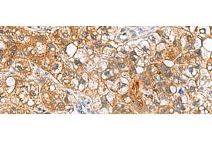 Immunohistochemistry of paraffin-embedded Human liver cancer tissue using TTR Polyclonal Antibody at dilution of 1:50(x200) (TTR antibody)