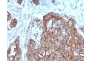 Formalin-fixed, paraffin-embedded human ovarian carcinoma stained with TFF1 antibody. (TFF1 antibody  (C-Term))