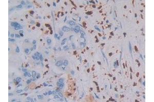 Detection of MASP1 in Human Bile duct cancer Tissue using Polyclonal Antibody to Mannose Associated Serine Protease 1 (MASP1) (MASP1 antibody  (AA 20-447))