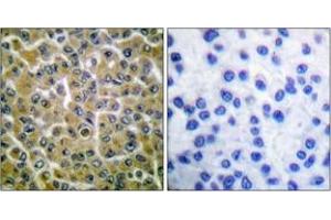 Immunohistochemistry analysis of paraffin-embedded human breast carcinoma, using PLCG2 (Phospho-Tyr753) Antibody. (Phospholipase C gamma 2 antibody  (pTyr753))