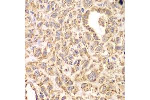 Immunohistochemistry of paraffin-embedded human esophageal cancer using HSPA9 antibody at dilution of 1:200 (400x lens). (HSPA9 antibody)