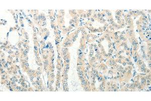 Immunohistochemistry of paraffin-embedded Human thyroid cancer tissue using RAB25 Polyclonal Antibody at dilution 1:50