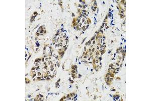 Immunohistochemistry of paraffin-embedded human breast cancer using MAPK9 antibody (ABIN5970592) at dilution of 1/100 (40x lens). (JNK2 antibody)