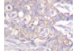 Immunohistochemistry analyzes of Csk antibody in paraffin-embedded human breast carcinoma tissue. (CSK antibody)