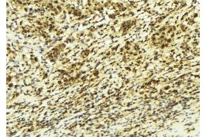 ABIN6277947 at 1/100 staining Human breast cancer tissue by IHC-P. (SIAH2 antibody  (C-Term))