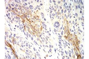 Immunohistochemical analysis of paraffin-embedded esophageal cancer tissues using KRT10 mouse mAb with DAB staining. (Keratin 10 antibody  (AA 345-454))