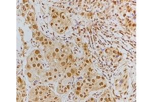 ABIN6256185 and ABIN6267192 at 1/100 staining Human breast cancer tissue by IHC-P. (tau antibody  (pSer202, pSer519))
