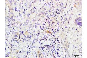Formalin-fixed and paraffin embedded human colon carcinoma tissue labeled with Anti-RRM1 Polyclonal Antibody, Unconjugated  at 1:200 followed by conjugation to the secondary antibody, (SP-0023), and DAB staining