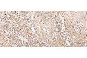 Immunohistochemistry of paraffin-embedded Human cervical cancer tissue using EPS15 Polyclonal Antibody at dilution of 1:50(x200) (EPS15 antibody)