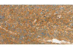 Immunohistochemistry of paraffin-embedded Human liver cancer using APOL2 Polyclonal Antibody at dilution of 1:80 (Apolipoprotein L 2 antibody)