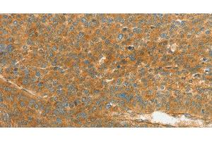Immunohistochemistry of paraffin-embedded Human liver cancer using APOL2 Polyclonal Antibody at dilution of 1:80