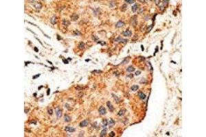 IHC analysis of FFPE human breast carcinoma tissue stained with the NRG1 antibody (Neuregulin 1 antibody  (AA 198-229))