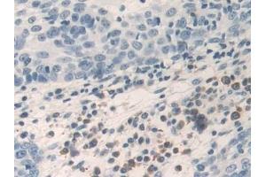 Detection of TNFa in Human Skin cancer Tissue using Polyclonal Antibody to Tumor Necrosis Factor Alpha (TNFa) (TNF alpha antibody  (AA 77-233))