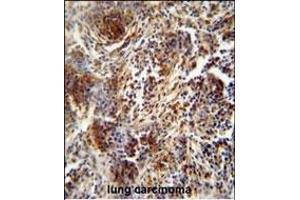 ZNF30 antibody (N-term) (ABIN654563 and ABIN2844269) immunohistochemistry analysis in formalin fixed and paraffin embedded human lung carcinoma followed by peroxidase conjugation of the secondary antibody and DAB staining. (ZFP30 antibody  (N-Term))