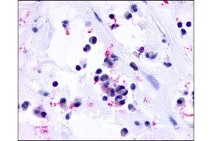 IHC staining of Nasal Mucosa (Allergic Rhinitis Eosinophils) using CysLT1 antibody ABIN122043. (CysLTR1 antibody  (3rd Extracellular Domain))