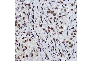 Immunohistochemistry of paraffin-embedded human breast cancer using Acetyl-Histone H3-K27 Rabbit mAb (ABIN3016650, ABIN3016651, ABIN3016652, ABIN1682513 and ABIN1682514) at dilution of 1:100 (40x lens). (Histone H3 (Acetyl K27) (acLys27) antibody)