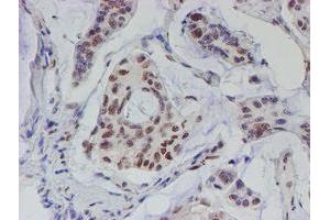 Immunohistochemical staining of paraffin-embedded Carcinoma of Human pancreas tissue using anti-TDO2 mouse monoclonal antibody. (TDO2 antibody)