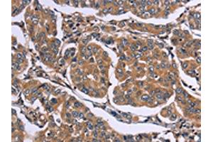 The image on the left is immunohistochemistry of paraffin-embedded Human breast cancer tissue using ABIN7190535(EGR4 Antibody) at dilution 1/20, on the right is treated with synthetic peptide.