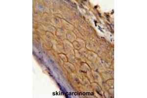 CB2 antibody (C-term) immunohistochemistry analysis in formalin fixed and paraffin embedded human skin carcinoma followed by peroxidase conjugation of the secondary antibody and DAB staining. (CNR2 antibody  (C-Term))