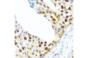 Immunohistochemistry of paraffin-embedded human prostate cancer using KHDRBS2 antibody. (KHDRBS2 antibody  (C-Term))